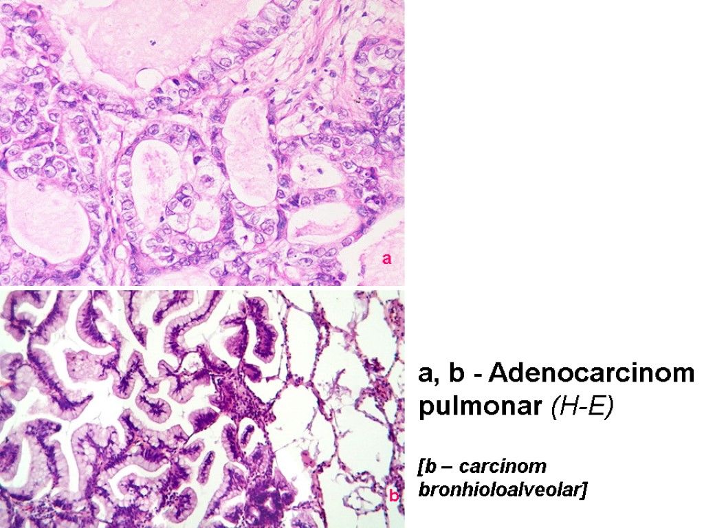 a, b - Adenocarcinom pulmonar (H-E) [b – carcinom bronhioloalveolar] a b